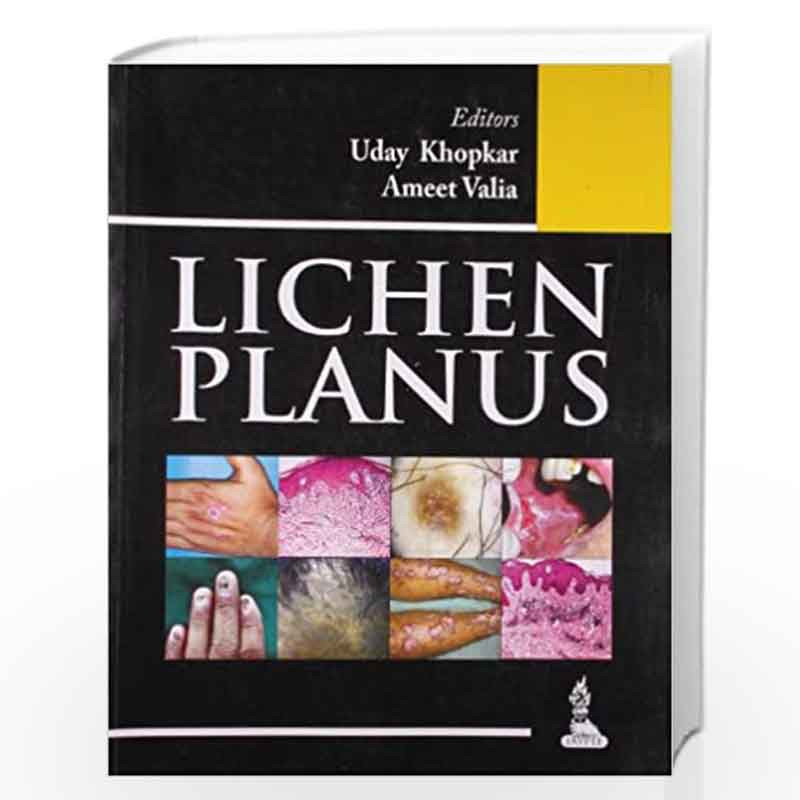 Lichen Planus by UDAY KHOPKAR Book-9789350904572