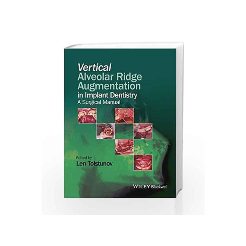 Vertical Alveolar Ridge Augmentation in Implant Dentistry: A Surgical Manual by Tolstunov L Book-9781119082590