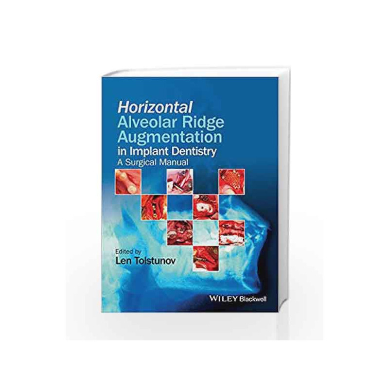 Horizontal Alveolar Ridge Augmentation in Implant Dentistry: A Surgical Manual by Tolstunov L Book-9781119019886